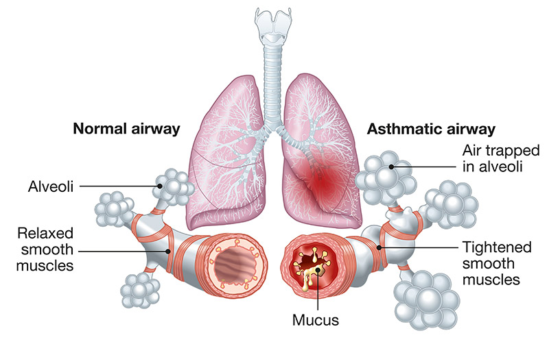 chronic care asthma